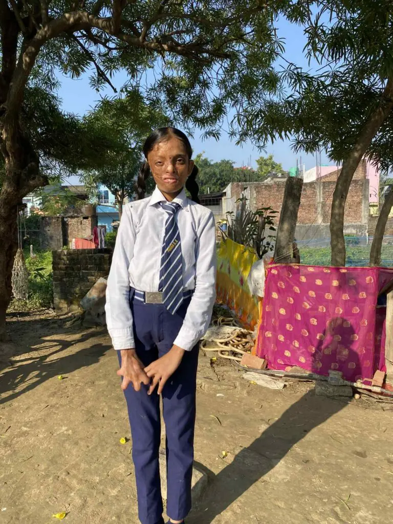 A person in a school uniform stands outdoors on a sunny day, with trees, brick walls, and colorful cloth in the background; their confident presence is a testament to the life-changing impact of free reconstructive surgery for burn survivors.