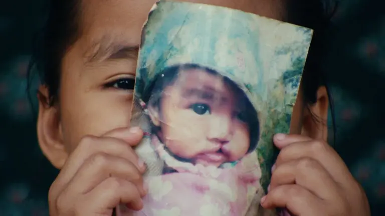 A child holds an old photograph of a baby with a cleft lip and palate in front of their face, aligning the photo with their features so that one eye is visible next to the baby picture.