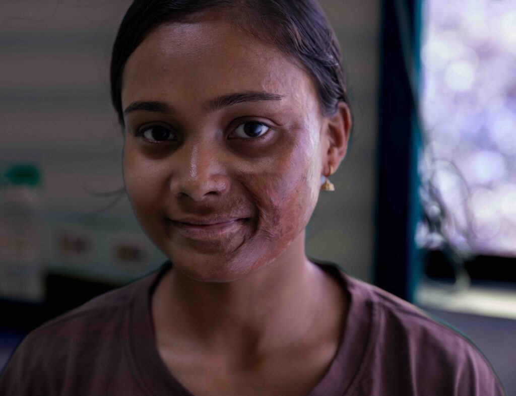 Burn Patient at Kirtipur Hospital - Updated Export