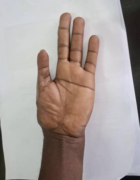 A left hand with four fingers extended and the thumb folded inward, as though awaiting thumb reconstruction, palm facing up, placed on a sheet of white paper.
